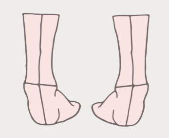 Supination and Running: 3 Key Signs You Need the Right Shoes to Prevent Injury 2
