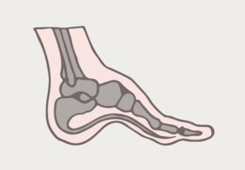 Supination and Running: 3 Key Signs You Need the Right Shoes to Prevent Injury 3